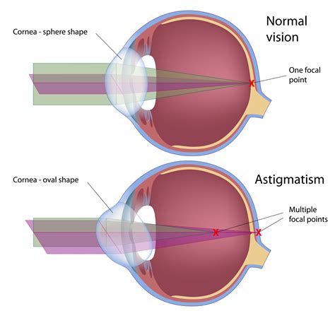 What Cause Astigmatism In The Eye